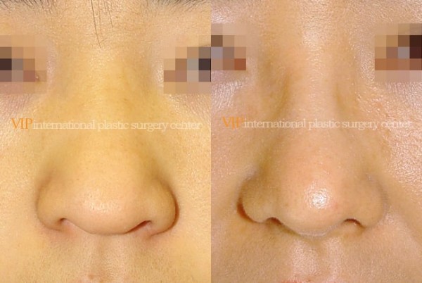 Nose Surgery - Long nose with Depressed columella