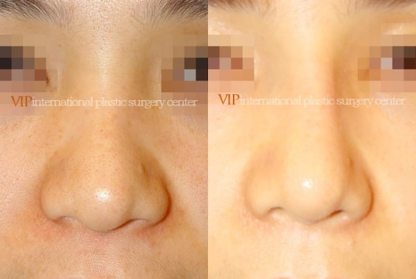 Nose Surgery - Rhinoplasty