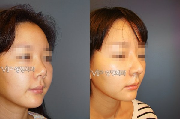 	Nose Surgery, Rib cartilage Rhinoplasty, Revision Rhinoplasty	 - Contraction due to silicone - Revision with Rib cartilage rhinoplasty