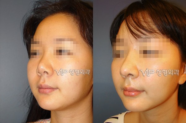 	Nose Surgery, Rib cartilage Rhinoplasty, Revision Rhinoplasty	 - Contraction due to silicone - Revision with Rib cartilage rhinoplasty