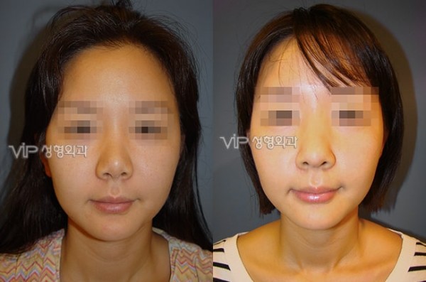 	Nose Surgery, Rib cartilage Rhinoplasty, Revision Rhinoplasty	 - Contraction due to silicone - Revision with Rib cartilage rhinoplasty