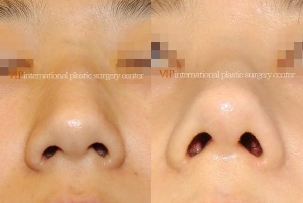 Nose Surgery - Rhinoplasty