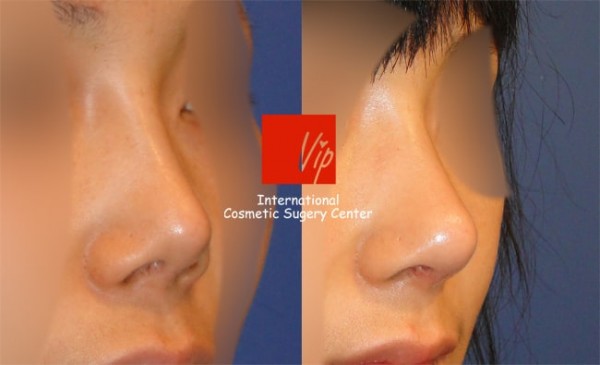 	Protruded Mouth Correction Rhinoplasty, Rib cartilage Rhinoplasty, Revision Rhinoplasty	 - Revision of silicone nose with Rib cartilage