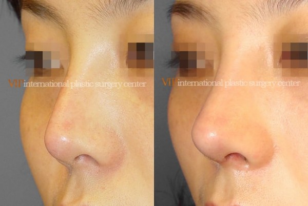Nose Surgery - Silicone infected nose revision