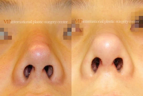 Nose Surgery - Silicone infected nose revision