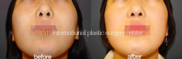 Facial Bone Surgery - Zygoma reduction