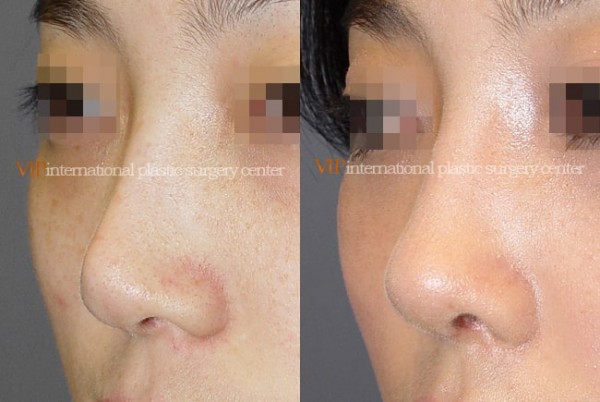 	Nose Surgery	 - Deviated tip correction