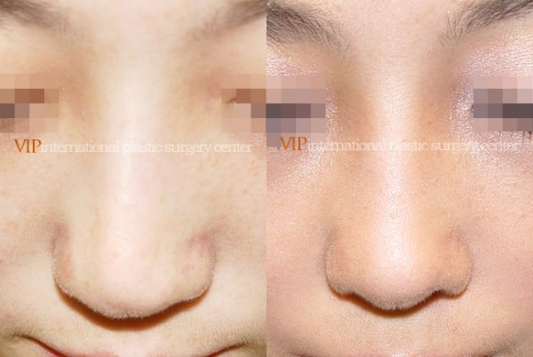 	Nose Surgery	 - Deviated tip correction