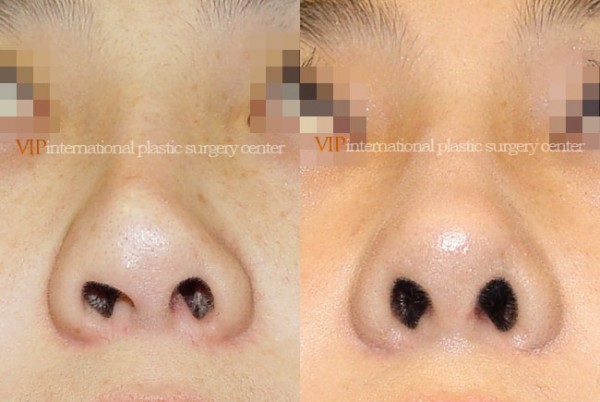 	Nose Surgery	 - Deviated tip correction