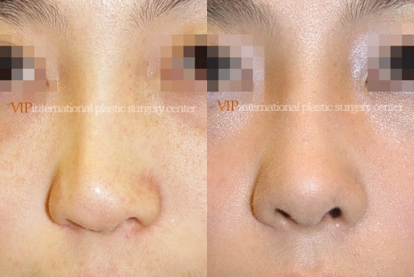 	Nose Surgery	 - Deviated tip correction