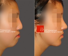 Humped nose correction (protruded mouth improvement as well)…