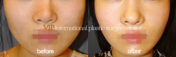 Facial Bone Surgery - Mandible & Zygoma reduction surgery
