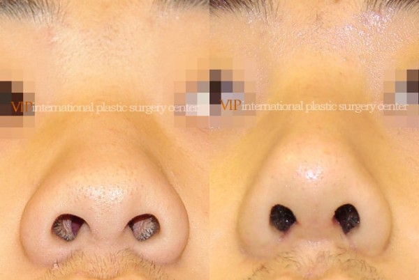 Nose Surgery - Rhinoplasty