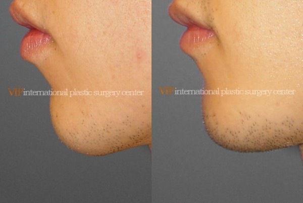 Facial Bone Surgery - Genioplasty