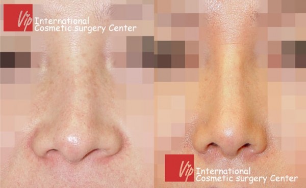 	Nose Surgery, Rib cartilage Rhinoplasty, Revision Rhinoplasty	 - Deviated nose correction