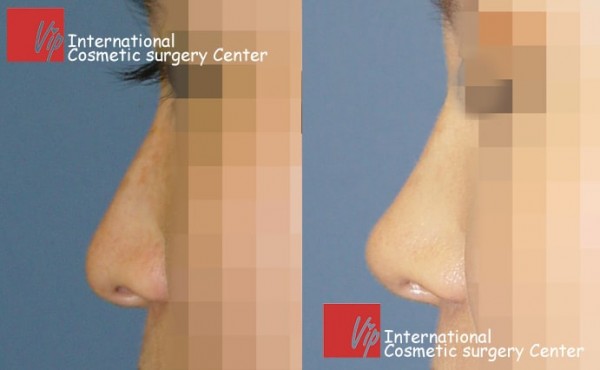 	Nose Surgery, Rib cartilage Rhinoplasty, Revision Rhinoplasty	 - Deviated nose correction