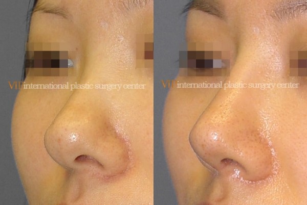 Nose Surgery - Bulbous nose rhinoplasty