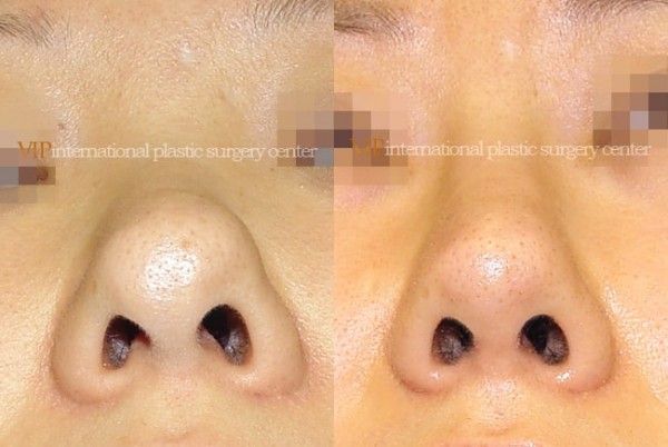 Nose Surgery - Bulbous nose rhinoplasty