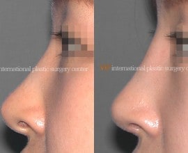Revision rhinoplasty - Silicone showing nose