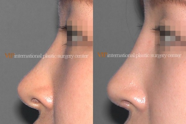 Nose Surgery - Revision rhinoplasty - Silicone showing nose