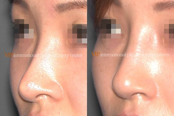 Nose Surgery - Revision rhinoplasty - Silicone showing nose