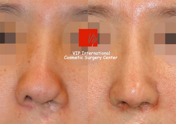 	Nose Surgery, Rib cartilage Rhinoplasty, Each Cases Nose	 - Cleft lip correction - Rib cartilage rhinoplasty