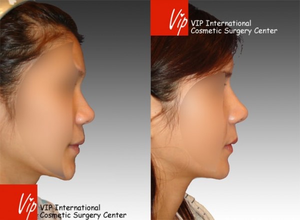 	Nose Surgery, Harmony-Rhinoplasty, Rib cartilage Rhinoplasty	 - Septal cartilage rhinoplasty - Wide nasal bone reduction & Alar base reduction