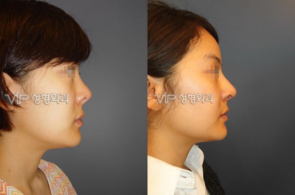 	Nose Surgery, Rib cartilage Rhinoplasty	 - Revision of short nose - Rib cartilage rhinoplasty