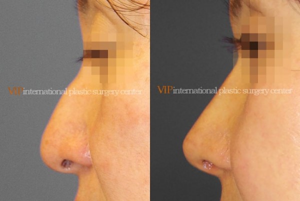 Nose Surgery - Rhinoplasty