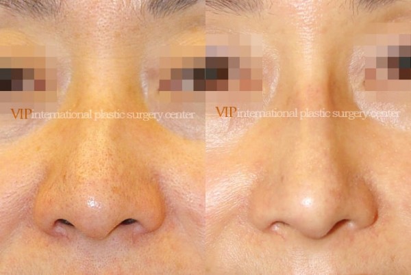 Nose Surgery - Rhinoplasty