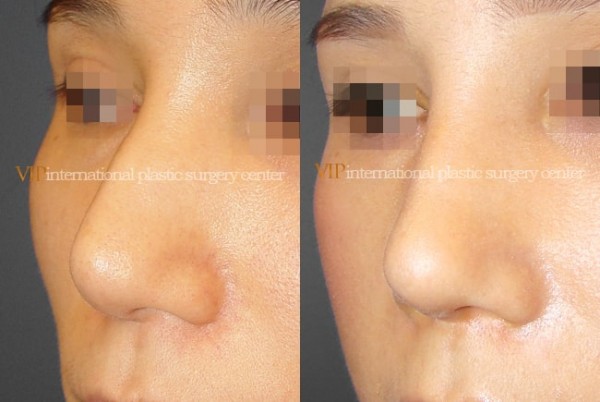 	Nose Surgery	 - Bulbous and deviated nose