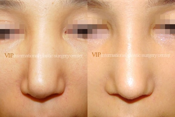 	Nose Surgery	 - Bulbous and deviated nose