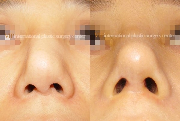 	Nose Surgery	 - Bulbous and deviated nose
