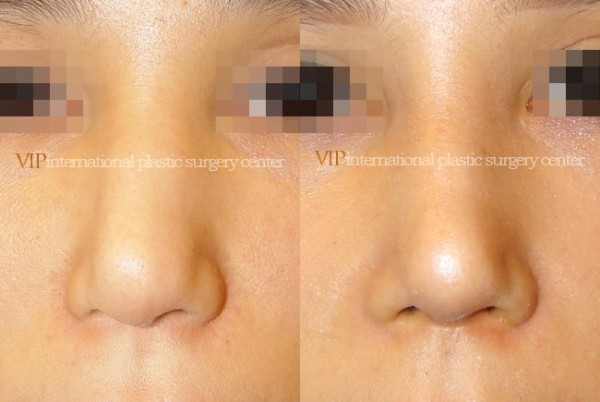 	Nose Surgery	 - Bulbous and deviated nose