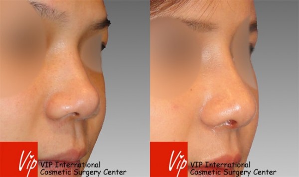 	Nose Surgery, Harmony-Rhinoplasty, Rib cartilage Rhinoplasty	 - Septal cartilage rhinoplasty - Wide nasal bone reduction & Alar base reduction