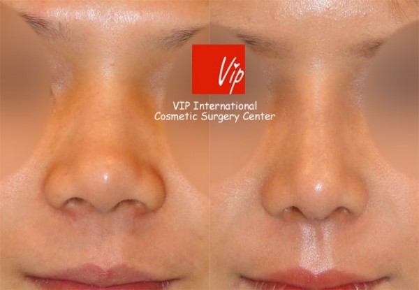 	Nose Surgery, Harmony-Rhinoplasty, Rib cartilage Rhinoplasty	 - Septal cartilage rhinoplasty - Wide nasal bone reduction & Alar base reduction