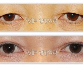 Upper blepharoplasty