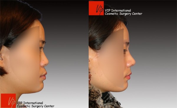 	Nose Surgery, Harmony-Rhinoplasty, Protruded Mouth Correction Rhinoplasty, Rib cartilage Rhinoplasty, Each Cases Nose	 - VIP Harmony rhinoplasty (correction of mid face retrusion & protruded mouth)