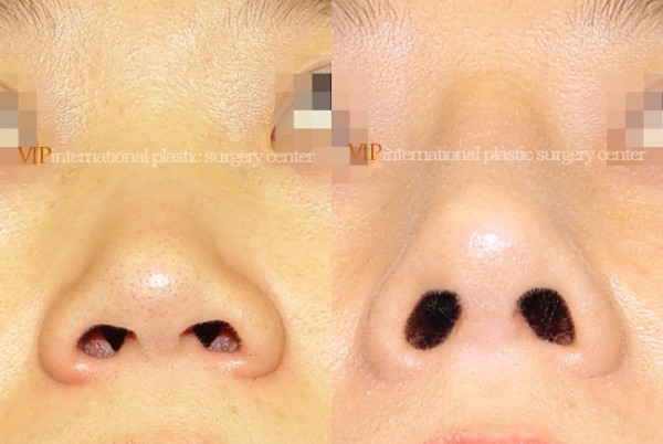 Nose Surgery - Alar base reduction