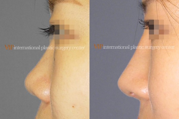 Nose Surgery - Alar base reduction