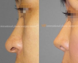 Long nose correction