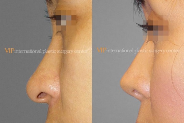 	Nose Surgery	 - Long nose correction