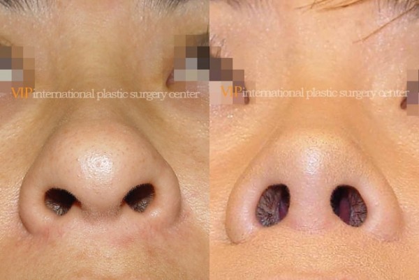 	Nose Surgery	 - Long nose correction