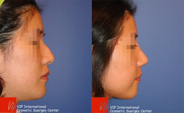 	Nose Surgery, Rib cartilage Rhinoplasty, Each Cases Nose	 - Humped nose correction rhinoplasty