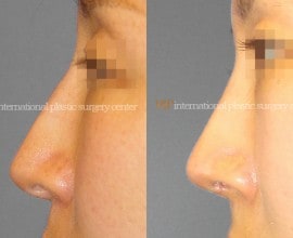 Long nose correction