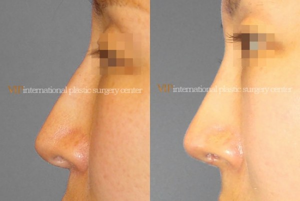 	Nose Surgery	 - Long nose correction