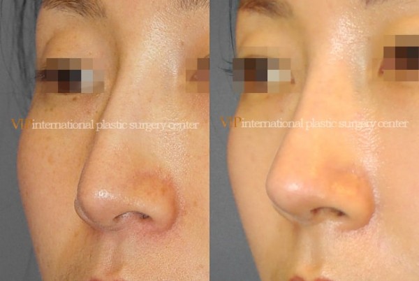 	Nose Surgery	 - Long nose correction