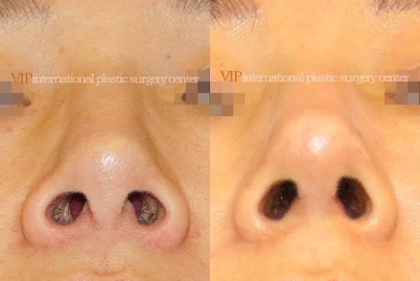 	Nose Surgery	 - Long nose correction