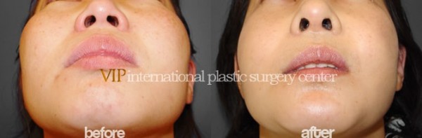 Facial Bone Surgery - Zygoma reduction