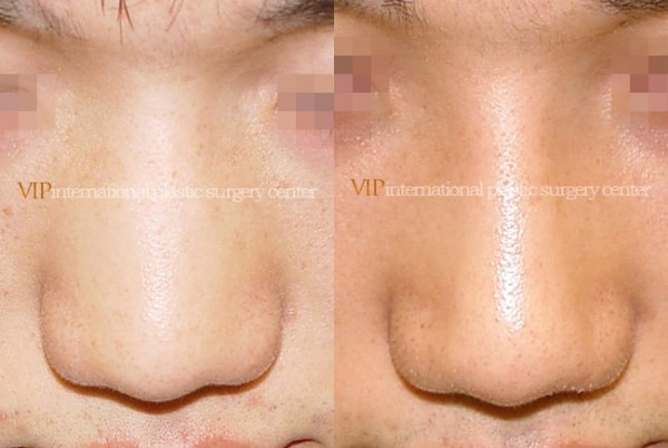 	Nose Surgery	 - Wide nasal bone reduction rhinoplasty